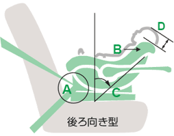 後ろ向き型の図